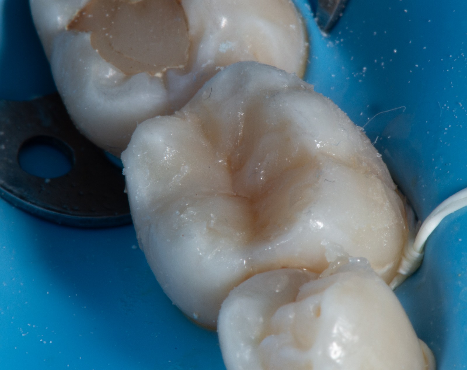 Molar restaurado con composite, anatomía recuperada