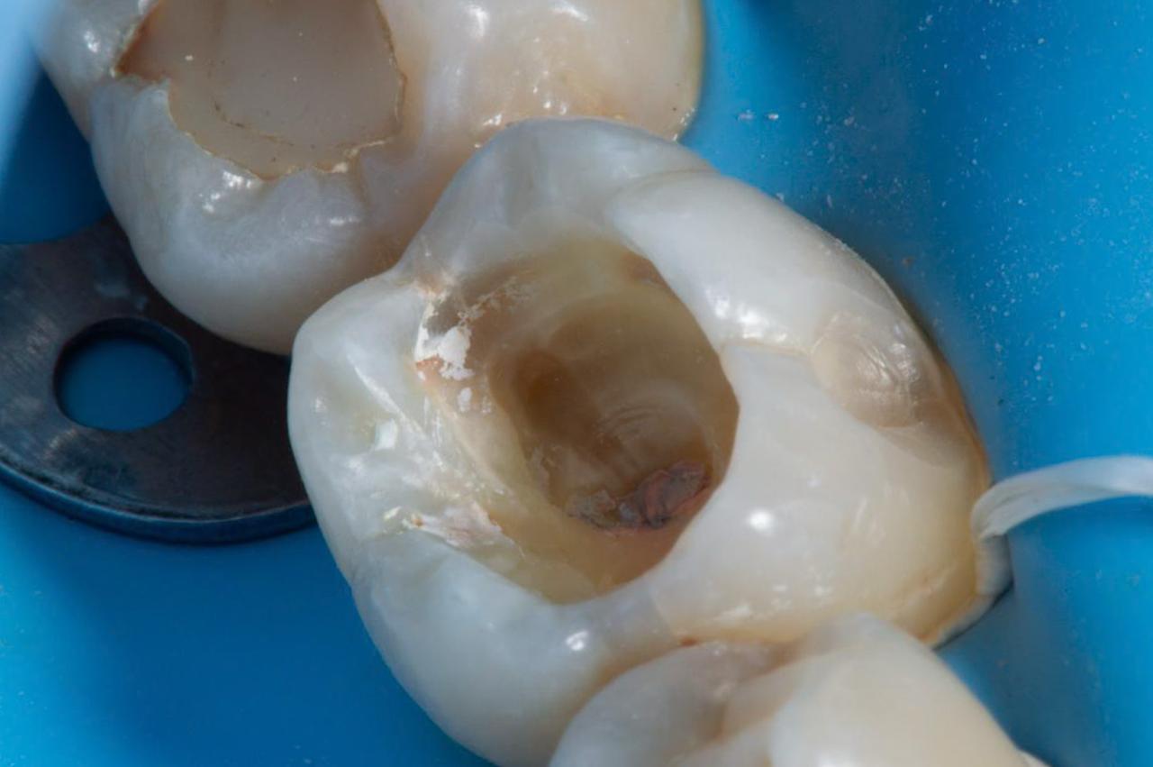 Molar con cavidad profunda antes del tratamiento