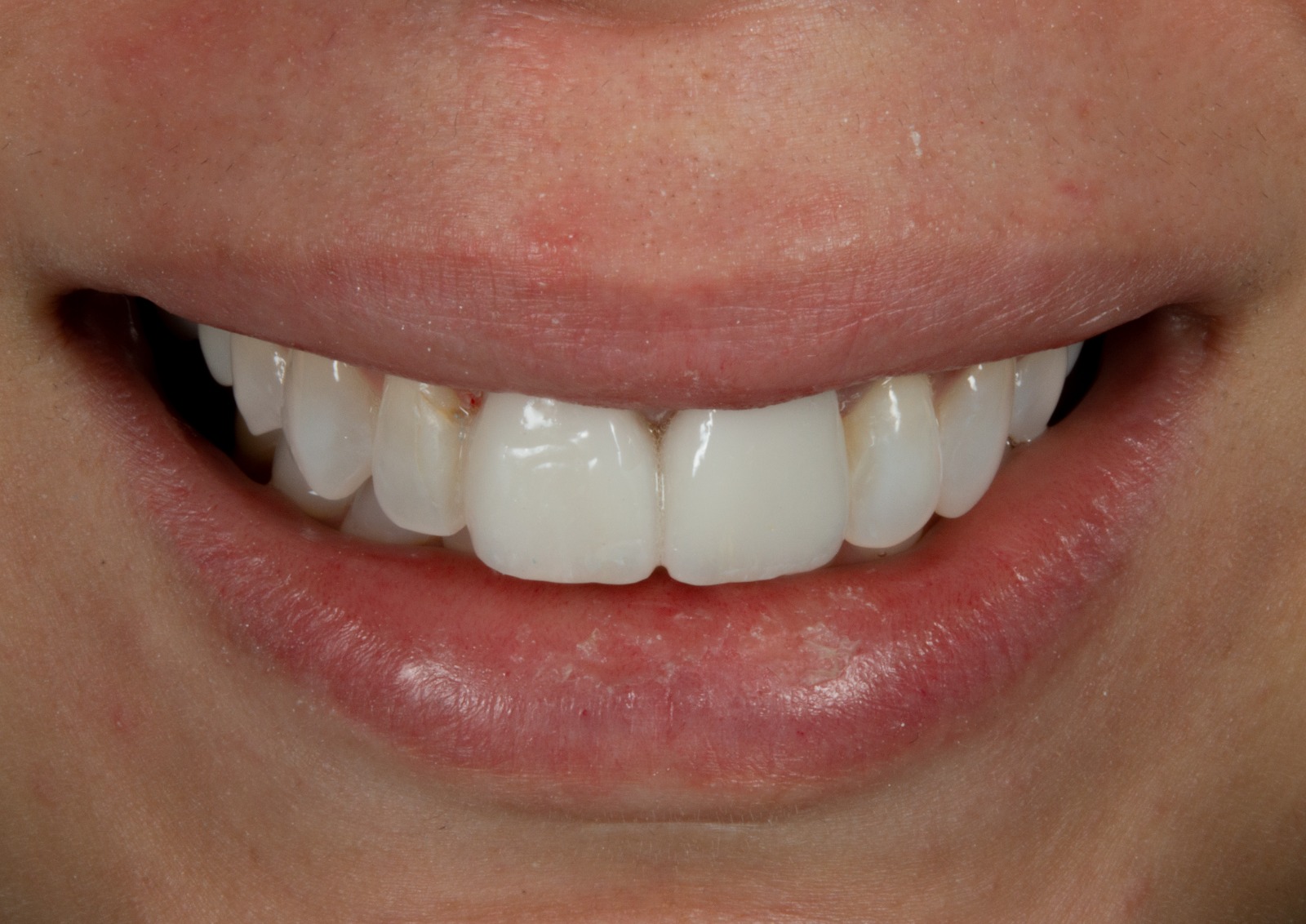 Sonrisa final tras la rehabilitación estética